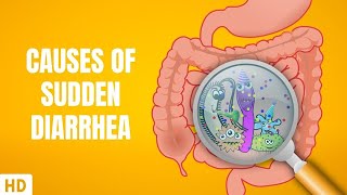 Causes of Sudden Diarrhea [upl. by Nicolella519]