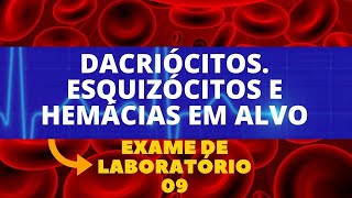 DACRIÃ“CITOS ESQUIZÃ“CITOS E HEMÃCIAS EM ALVO  ALTERAÃ‡Ã•ES NO HEMOGRAMA HEMATOLOGIA [upl. by Nnylsaj]