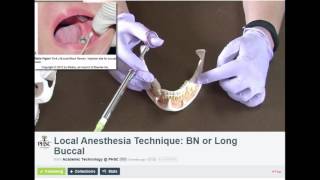 Long Buccal Dental Anesthesia Technique [upl. by Drarrej959]