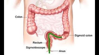 Flexible Sigmoidoscopy  Definition Uses Steps procedure Indications Contraindications [upl. by Biernat]