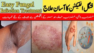 Fungal Infection Ka Asan Ilaj  Easy Fungal Infection Treatment  خراب ناخن کا علاج DrKashif Bilal [upl. by Tray317]