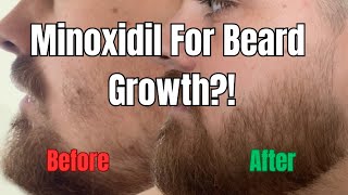 1 Year of Using Minoxidil For Beard Growth  Minoxidil for Beard Before and After [upl. by Nair]