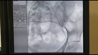 Thrombus aspiration and catheter directed thrombolysis Deepak Heart Institute [upl. by Obala]