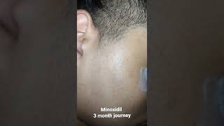 minoxidil 5 beard growth 3 month journey mintop minoxidil [upl. by Ellened]