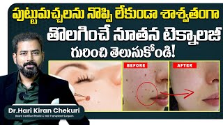 How to Remove Mole Permanently  Mole Removal Laser Treatment in Hyderabad  ReDefine Channel [upl. by Anaehr]