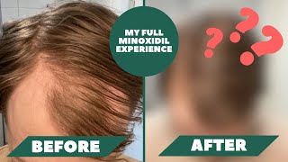 I Have Been Using Minoxidil For 1 Year And Here Are The Results  My Full Minoxidil Experience [upl. by Lossa713]