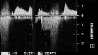 Diastolic Mitral Regurgitation [upl. by Pettit]