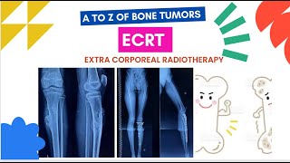 ECRT Extra corporeal radiotherapy for Bone Tumors Osteosarcoma Tibia or Leg Diaphysis area [upl. by Jeane]