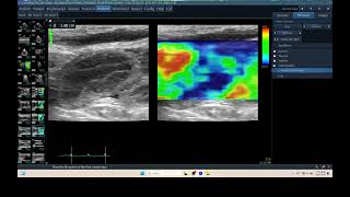 IQ 315 PYOMETRA ULTRASOUND ECHOPAC ANALYSIS UTERUS ELASTOGRAPHY [upl. by Birecree]