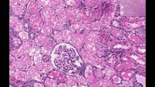 Histopathology Kidney Acute tubular necrosis [upl. by Hsivat775]