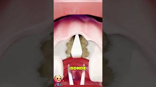 Dientes Nuevos con el Hueso de tu Cadera 😲🦷 [upl. by Feilak481]