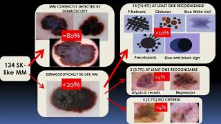 Seborrheic Keratosislike melanomas  Dr Cristina Carrera [upl. by Caddric620]