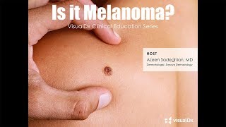 Is it melanoma [upl. by Coffee217]