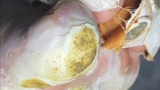 Pedicure video25，vertical plantaris，plantar wart [upl. by Anelat]