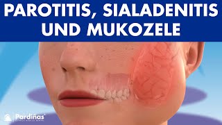 MUMPS Parotitis und andere Speicheldrüsenprobleme Sialadenitis Sialolithiasis Mukozele © [upl. by Benoit795]