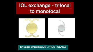 Intraocular Lens Exchange  IOL EXCHANGE from Trifocal to Monofocal  Dr Sagar Bhargava [upl. by Wordoow25]