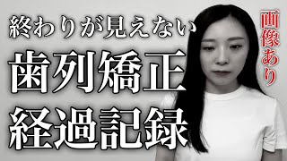 【歯列矯正】あれから2年。終わりが見えない。歯列矯正経過記録画像あり アンフィットamp骨隆起amp圧下 [upl. by Noret]