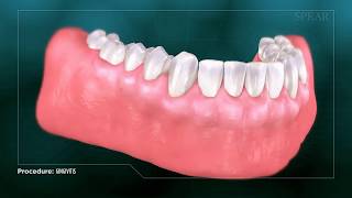 Gingivitis  Inflamed Gums [upl. by Kaasi]