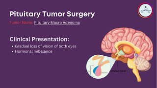 Pituitary Macro Adenoma Surgery [upl. by Nauqes6]