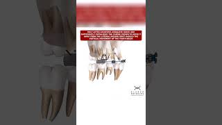 CANINES OVER THE ROOTS OF THE LATERAL INCISORS  ORTHODONTIC TIPS Shorts [upl. by Greysun]