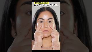 Transform YOUR Under Eye Hollow Instantly [upl. by Attenauq]