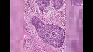 Histopathology Cervix Squamous cell carcinoma [upl. by Perron647]