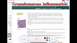 Granulomatous Inflammation Pathology 33  First Aid USMLE Step 1 in UrduHindi [upl. by Donnamarie104]