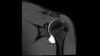 MRI Shoulder part 6 SLAP tear [upl. by Rodablas]