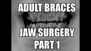 My Jaw Surgery and Braces Part 1 [upl. by Eelta]