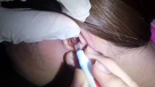 Young Womans Super Massive Earwax Removal [upl. by Gasser]