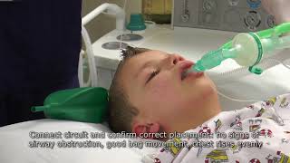 Paediatric Anaesthetics Chapter 2  LMA insertion 1 [upl. by Wein837]