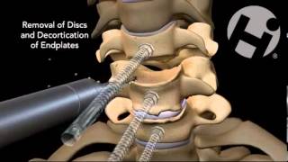 CERVICAL SURGERY C5C6C7 [upl. by Acinot432]