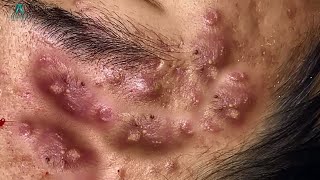 Big Cystic Acne Blackheads Extraction Blackheads amp Milia Whiteheads Removal Pimple Popping [upl. by Haidabej]