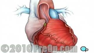 Heart Health Cardiac Catheterization Surgery PreOp® Patient Education [upl. by Atteuqahc]