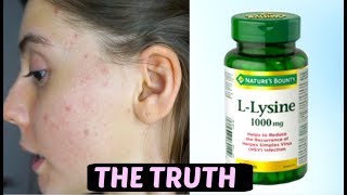 I TOOK LYSINE FOR 2 WEEKS STRAIGHT THIS IS WHAT HAPPENED TO ACNE SCARS [upl. by Estele]