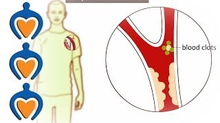 Thrombosis  What is it and how is it treated [upl. by Doran]