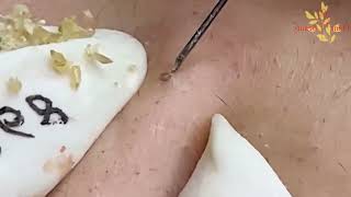 Removal blackheads and whitehead extraction 140 [upl. by Ylam]