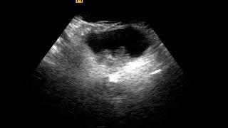 Urinary Bladder Mass  Differential Diagnosis [upl. by Enileda]