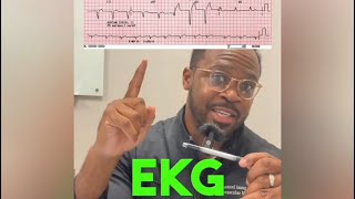 Heart Doctor Explains Left Bundle Branch Block [upl. by Templer172]