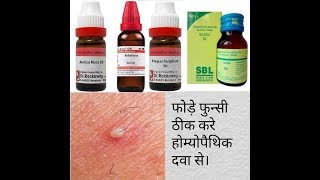 Boils homoeopathic medicine फोड़ों और फुंसी दूर करे by carewell homoeopathy [upl. by Ivatts]