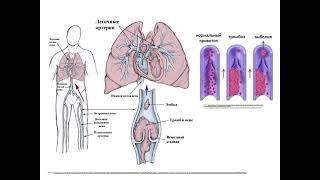 Thrombosis EmbolismViolations microcirculation [upl. by Halil886]