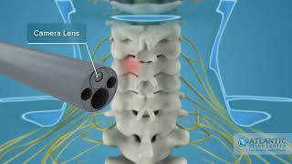 What is Endoscopic Posterior Cervical Discectomy and Foraminotomy AtlanticSpineCenter [upl. by Newol]