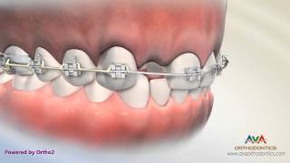 Orthodontic amp Restorative Treatment for Missing Lateral Incisor  Different Options [upl. by Annemarie]