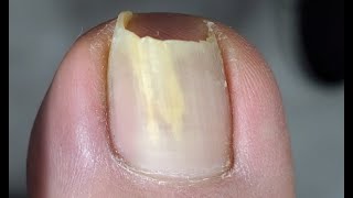 Five nails are ingrown nails  Pedicure tutorial [upl. by Rocher]