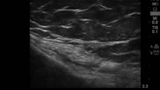 Ultrasound guided pes anserine bursitis injection [upl. by Nosnorb]