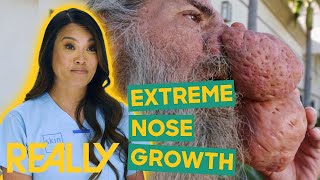 Dr Lee Sees Man With An Extreme Nose Growth  Dr Pimple Popper Pop Ups [upl. by Kcin]