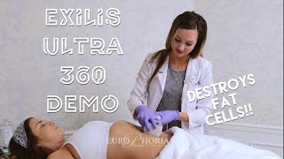 EXILIS ULTRA DEMONSTRATION BODY  Exilis Ultra 360 Experience at EuroPhoria [upl. by Vola659]