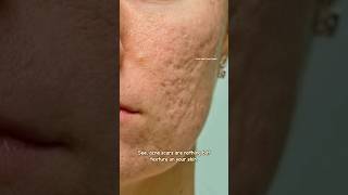 How to get rid of acne scars with Tretinoin  Acne scar Treatment sristydutta acnescars shorts [upl. by Leahcimnhoj]