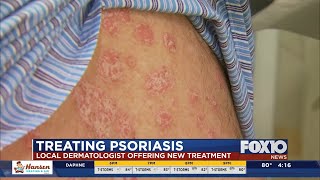 New treatment for psoriasis [upl. by Anrim]