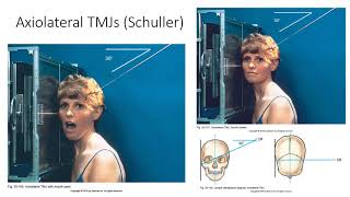 Radiographic Positioning of the TMJs [upl. by Ruella]